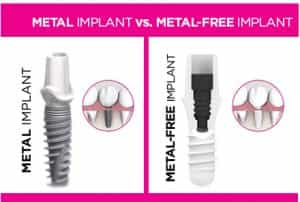 metal-and-metal-free-comparison-V2-300x202